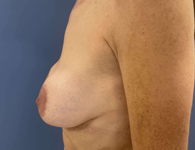 Before Image of Breast Revision with Capsulectomy Left Side View Case 4910