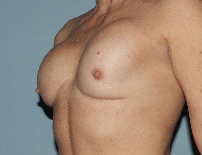 before breast revision - ruptured implant left angle case 4938