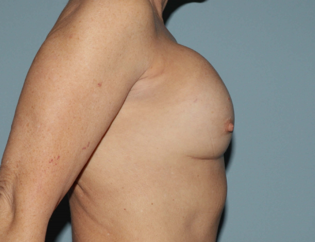 before breast revision - ruptured implant right angle case 4938