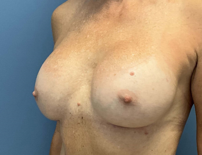 after breast revision - ruptured implant left angle case 4938