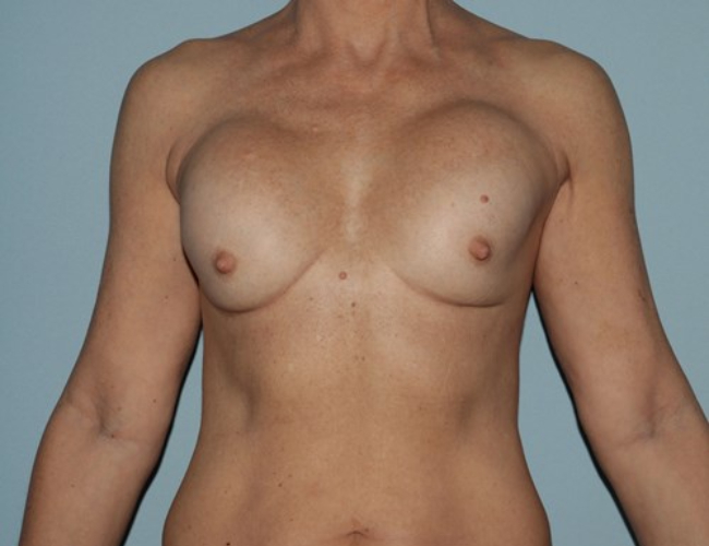 after breast revision - ruptured implant Front side view case 4938