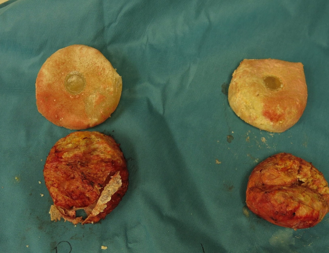 multiple severe capsular contracture implant removed case 7400