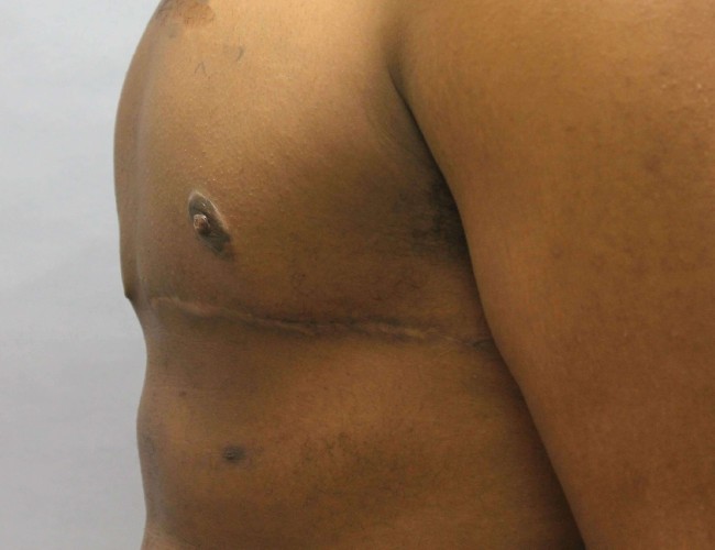 image after gynecomastia - sagging male breast with mastectomy left angle case 6703