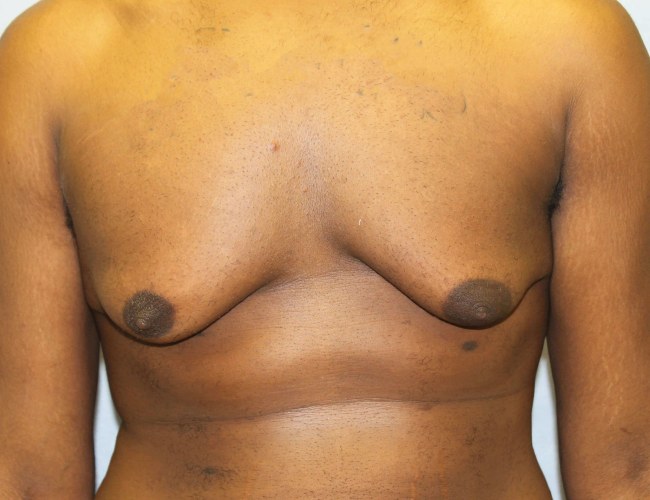 image before gynecomastia - sagging male breast with mastectomy front view case 6703