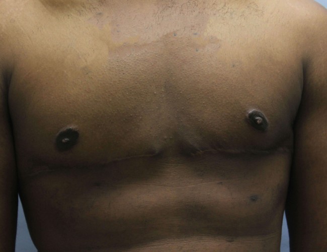 image after gynecomastia - sagging male breast with mastectomy front view case 6703