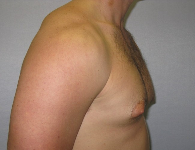image before gynecomastia - prominent nipples right angle case 6713