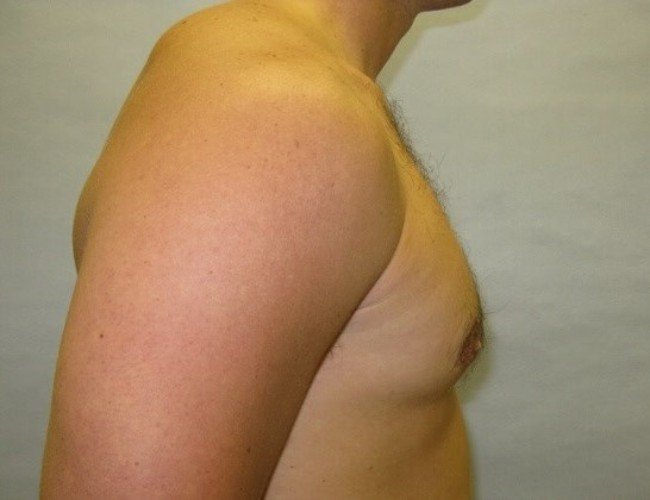image after gynecomastia - prominent nipples right angle case 6713
