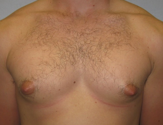 image before gynecomastia - prominent nipples front view case 6713