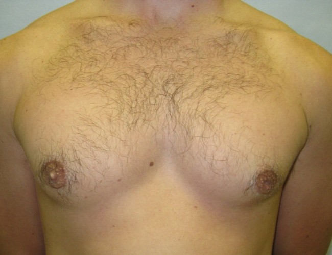 image after gynecomastia - prominent nipples front view case 6713