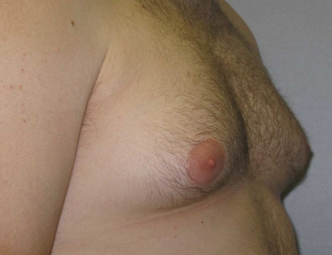 image before liposuction treatment of gynecomastia - right angle case 6722