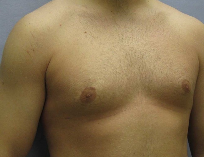 image after liposuction treatment of gynecomastia - right angle case 6722