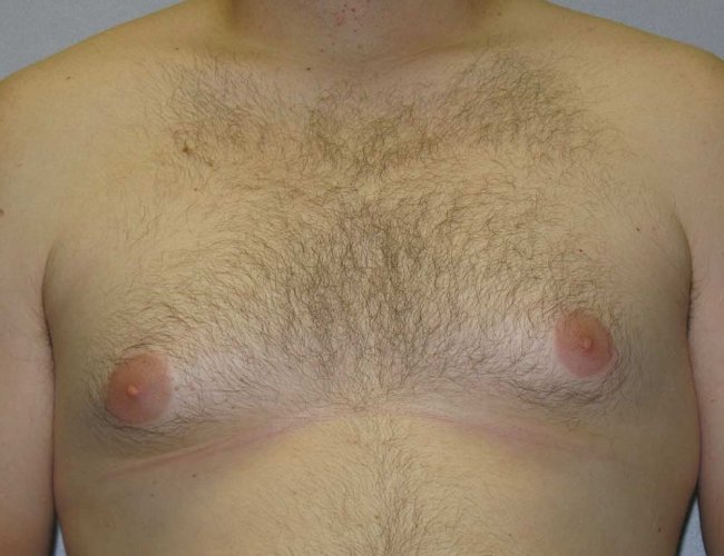 image before liposuction treatment of gynecomastia - front view case 6722