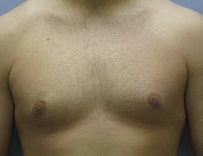 image after liposuction treatment of gynecomastia - front view case 6722