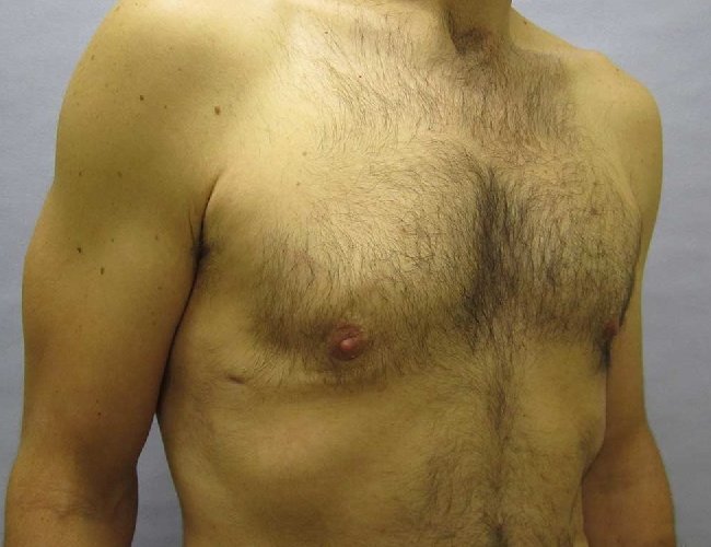 image after gynecomastia with liposuction - right angle case 6731