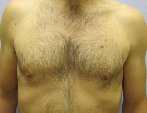 image after gynecomastia with liposuction - front view case 6731