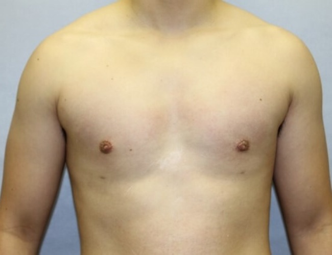 image after gynecomastia treatment - front view case 6750