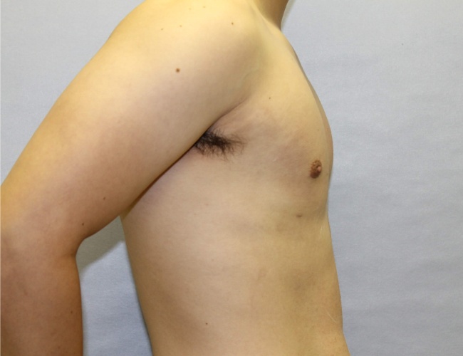 image after gynecomastia treatment - right angle case 6750