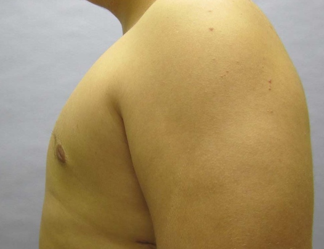 image after gynecomastia - young man patient left angle case 6837