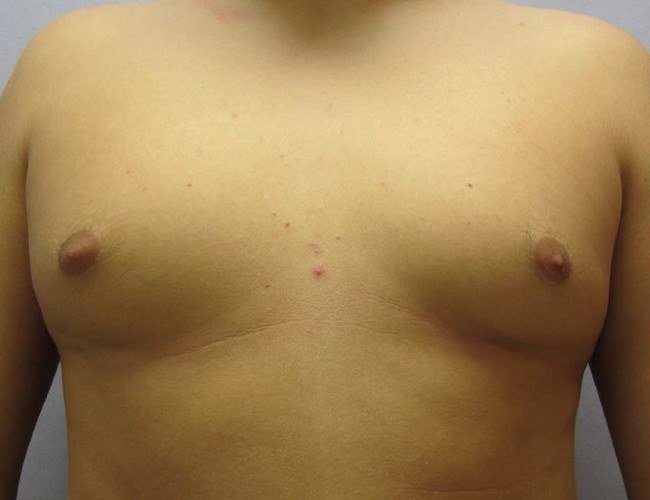 image before gynecomastia - young man patient front view case 6837