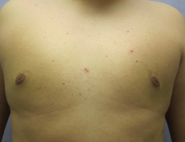 image after gynecomastia - young man patient front view case 6837