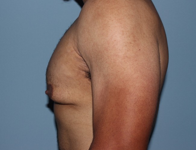 image before minimal incision gynecomastia - left angle case 6842