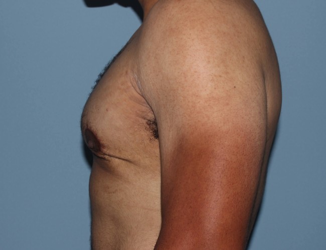 image after minimal incision gynecomastia - left angle case 6842