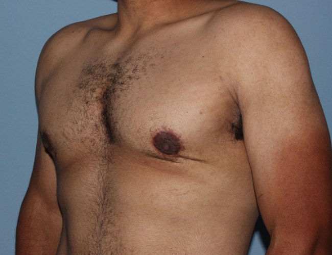 image after minimal incision gynecomastia - 45 degrees left angle case 6842
