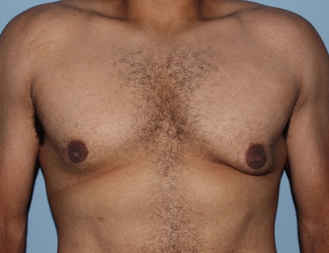 image before minimal incision gynecomastia - front view case 6842