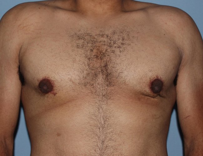 image after minimal incision gynecomastia - front view case 6842