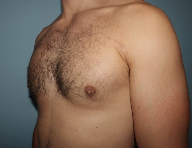 image after gynecomastia with vaser - 45 degrees left angle case 6851
