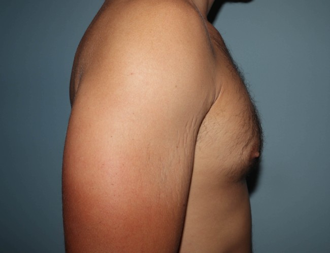image before gynecomastia with vaser - right angle case 6851