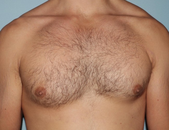 image before gynecomastia with vaser - front view case 6851