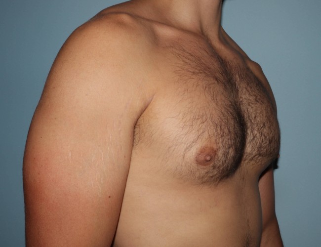 image before gynecomastia with vaser - 45 degrees right angle case 6851