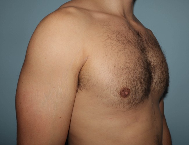 image after gynecomastia with vaser - 45 degrees right angle case 6851