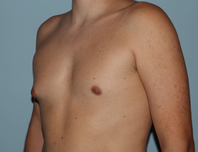 image before unilateral gynecomastia with hybrid technique - left angle case 6860