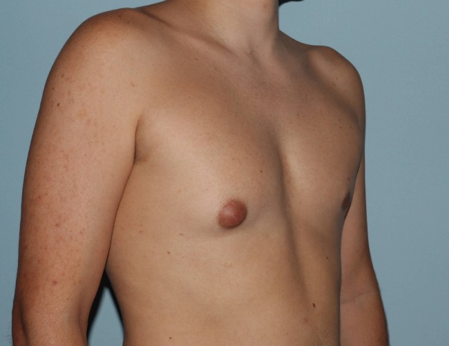 image before unilateral gynecomastia with hybrid technique - right angle case 6860