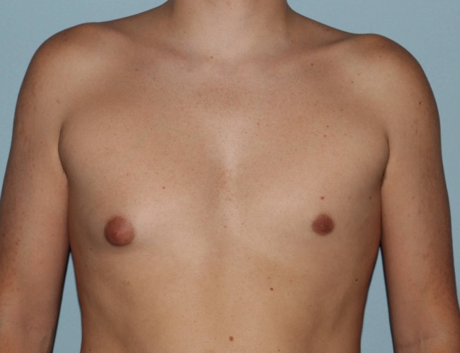 image before unilateral gynecomastia with hybrid technique - front view case 6860