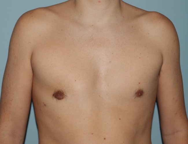 image after unilateral gynecomastia with hybrid technique - front view case 6860