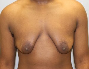 image before gynecomastia - sagging male breast front view case 6867