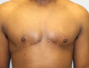 image after gynecomastia - sagging male breast front view case 6867