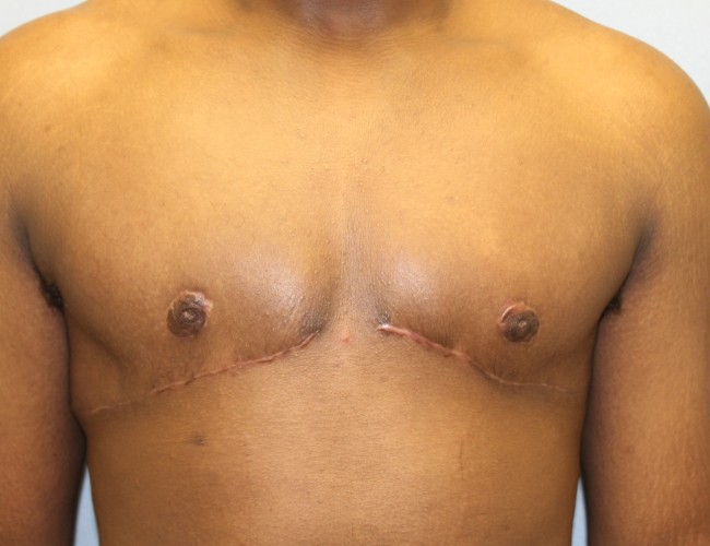 image after gynecomastia - sagging male breast front view case 6867