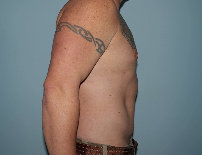 image after gynecomastia with vaser liposuction - male patient right angle case 6871