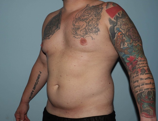 image before gynecomastia with vaser liposuction - male patient 45 degrees left case 6871