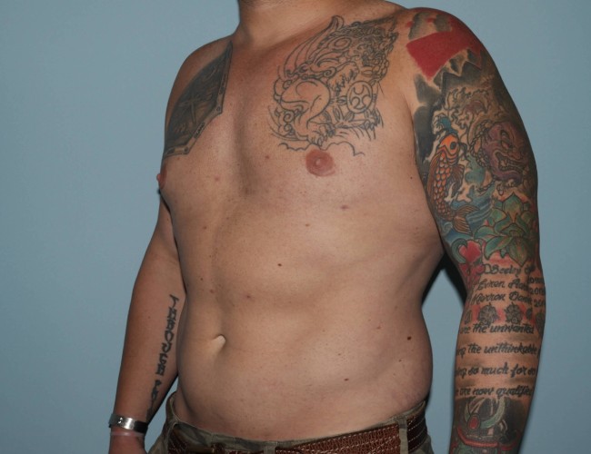 image after gynecomastia with vaser liposuction - male patient 45 degrees left angle case 6871