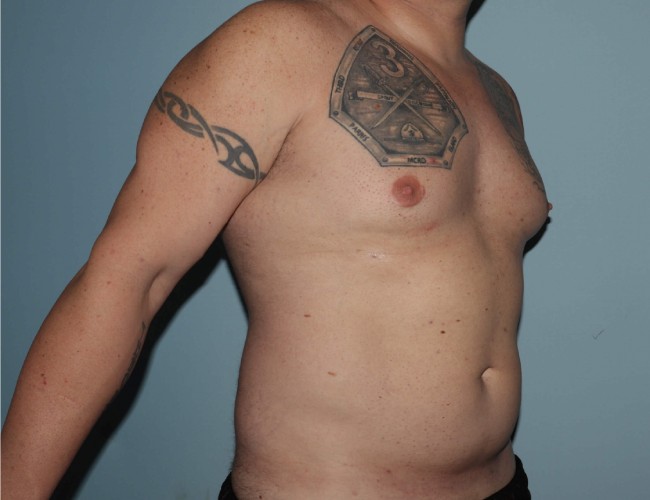 image before gynecomastia with vaser liposuction - male patient 45 degrees right angle case 6871