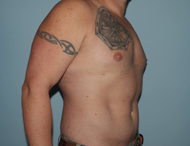 image after gynecomastia with vaser liposuction - male patient 45 degrees right angle case 6871