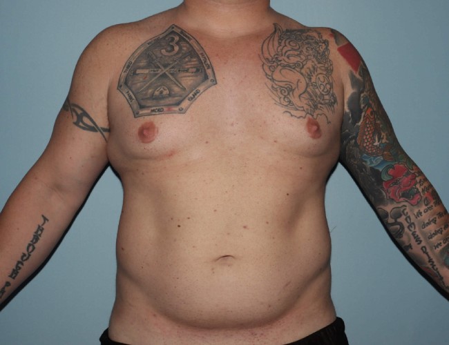 image before gynecomastia with vaser liposuction - male patient front view case 6871