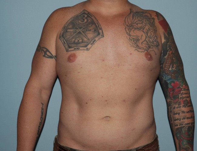 image after gynecomastia with vaser liposuction - male patient front view case 6871