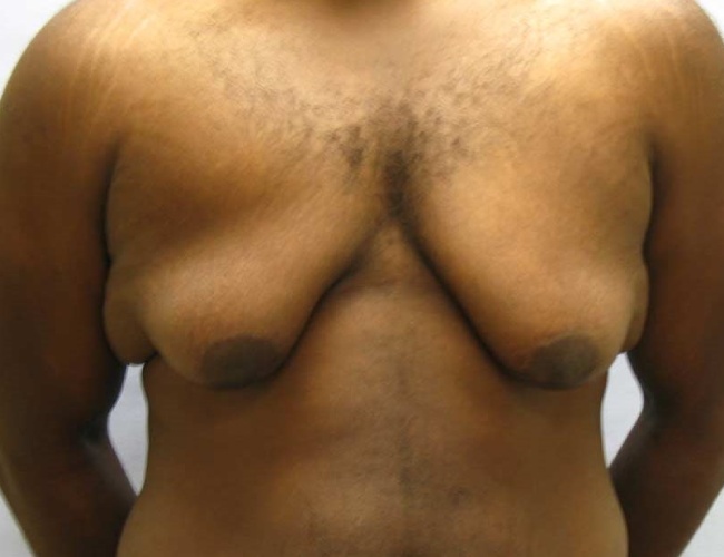 image before severe gynecomastia - front view case 6880