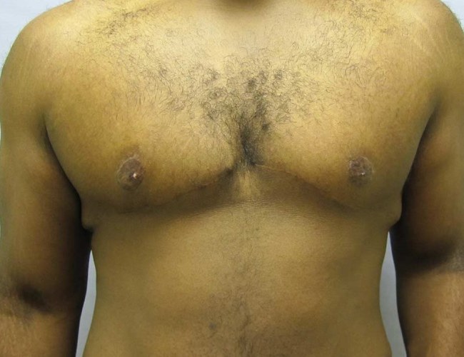 image after severe gynecomastia - front view case 6880